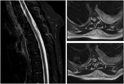 Diagnostic dilemma in acute neurological presentation of spinal arachnoid cysts: A case report